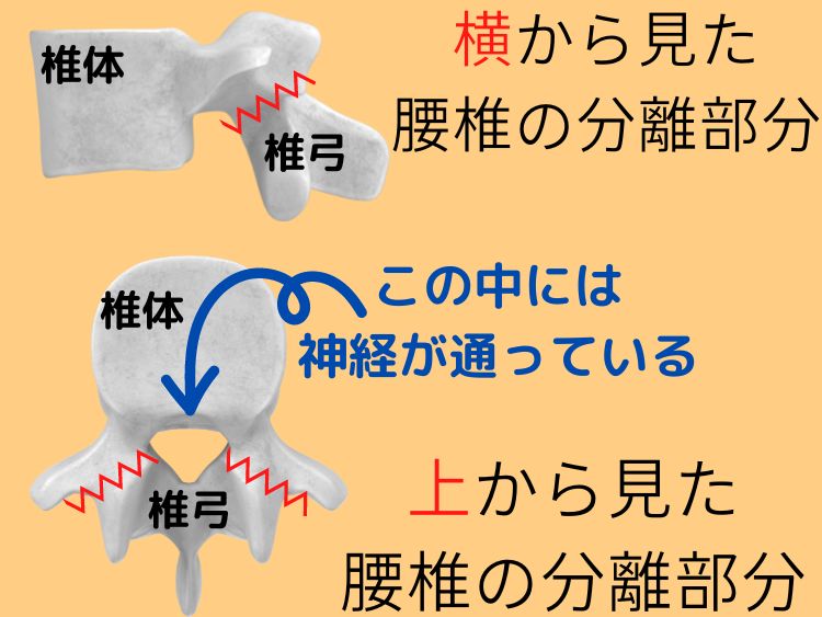 腰椎分離症　イラスト　あゆは整体院